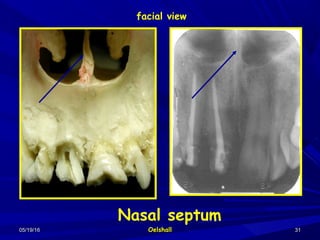 05/19/1605/19/16 OelshallOelshall 3131
Nasal septum
facial view
 