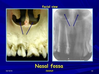 05/19/1605/19/16 OelshallOelshall 3232
Nasal fossa
facial view
 
