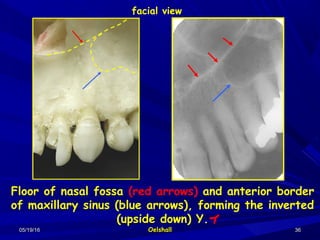 05/19/1605/19/16 OelshallOelshall 3636
Floor of nasal fossa (red arrows) and anterior border
of maxillary sinus (blue arrows), forming the inverted
(upside down) Y.Y
facial view
 