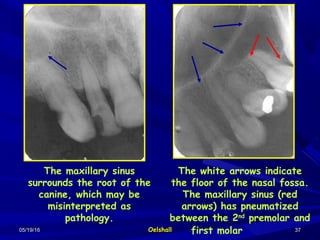 05/19/1605/19/16 OelshallOelshall 3737
The maxillary sinus
surrounds the root of the
canine, which may be
misinterpreted as
pathology.
The white arrows indicate
the floor of the nasal fossa.
The maxillary sinus (red
arrows) has pneumatized
between the 2nd
premolar and
first molar
 