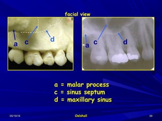 05/19/1605/19/16 OelshallOelshall 3939
a = malar process
c = sinus septum
d = maxillary sinus
a c d dca
facial view
 