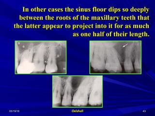 05/19/1605/19/16 OelshallOelshall 4343
In other cases the sinus floor dips so deeplyIn other cases the sinus floor dips so deeply
between the roots of the maxillary teeth thatbetween the roots of the maxillary teeth that
the latter appear to project into it for as muchthe latter appear to project into it for as much
as one half of their length.as one half of their length.
 