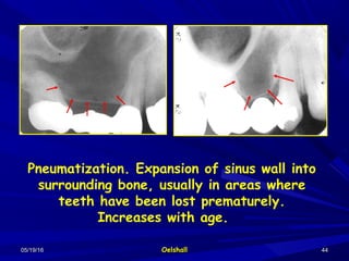 05/19/1605/19/16 OelshallOelshall 4444
Pneumatization. Expansion of sinus wall into
surrounding bone, usually in areas where
teeth have been lost prematurely.
Increases with age.
 