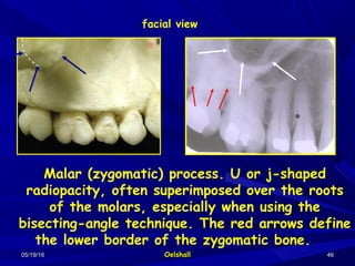 05/19/1605/19/16 OelshallOelshall 4646
Malar (zygomatic) process. U or j-shaped
radiopacity, often superimposed over the roots
of the molars, especially when using the
bisecting-angle technique. The red arrows define
the lower border of the zygomatic bone.
facial view
 