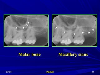 05/19/1605/19/16 OelshallOelshall 4747
Malar bone Maxillary sinus
 