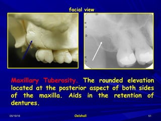 05/19/1605/19/16 OelshallOelshall 5151
Maxillary Tuberosity. The rounded elevation
located at the posterior aspect of both sides
of the maxilla. Aids in the retention of
dentures.
facial view
 