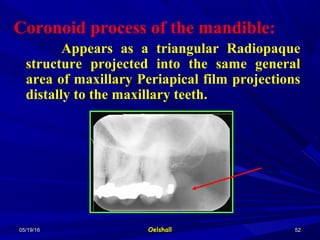 05/19/1605/19/16 OelshallOelshall 5252
Coronoid process of the mandible:
Appears as a triangular Radiopaque
structure projected into the same general
area of maxillary Periapical film projections
distally to the maxillary teeth.
 