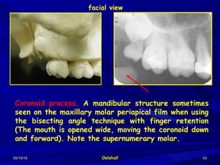 05/19/1605/19/16 OelshallOelshall 5353
Coronoid process. A mandibular structure sometimes
seen on the maxillary molar periapical film when using
the bisecting angle technique with finger retention
(The mouth is opened wide, moving the coronoid down
and forward). Note the supernumerary molar.
facial view
 