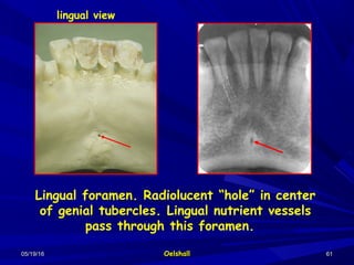 05/19/1605/19/16 OelshallOelshall 6161
Lingual foramen. Radiolucent “hole” in center
of genial tubercles. Lingual nutrient vessels
pass through this foramen.
lingual view
 