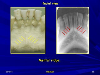 05/19/1605/19/16 OelshallOelshall 6565
Mental ridge.
facial view
 