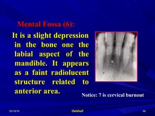 05/19/1605/19/16 OelshallOelshall 6666
Mental Fossa (6):Mental Fossa (6):
It is a slight depressionIt is a slight depression
in the bone one thein the bone one the
labial aspect of thelabial aspect of the
mandible. It appearsmandible. It appears
as a faint radiolucentas a faint radiolucent
structure related tostructure related to
anterior area.anterior area. Notice: 7 is cervical burnout
 