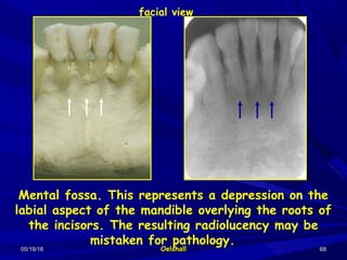 05/19/1605/19/16 OelshallOelshall 6868
Mental fossa. This represents a depression on the
labial aspect of the mandible overlying the roots of
the incisors. The resulting radiolucency may be
mistaken for pathology.
facial view
 