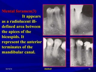 05/19/1605/19/16 OelshallOelshall 7070
Mental foramen(3)Mental foramen(3)
It appearsIt appears
as a radiolucent ill-as a radiolucent ill-
defined area betweendefined area between
the apices of thethe apices of the
bicuspids. Itbicuspids. It
represent the anteriorrepresent the anterior
terminates of theterminates of the
mandibular canal.mandibular canal.
 
