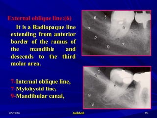 05/19/1605/19/16 OelshallOelshall 7575
External oblique line:(6)
It is a Radiopaque line
extending from anterior
border of the ramus of
the mandible and
descends to the third
molar area.
7-Internal oblique line,
7-Mylohyoid line,
9-Mandibular canal,
 