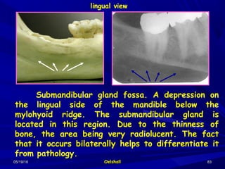 05/19/1605/19/16 OelshallOelshall 8383
lingual view
Submandibular gland fossa. A depression on
the lingual side of the mandible below the
mylohyoid ridge. The submandibular gland is
located in this region. Due to the thinness of
bone, the area being very radiolucent. The fact
that it occurs bilaterally helps to differentiate it
from pathology.
 