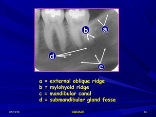 05/19/1605/19/16 OelshallOelshall 8484
ab
c
dd
a = external oblique ridge
b = mylohyoid ridge
c = mandibular canal
d = submandibular gland fossa
 