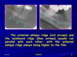 05/19/1605/19/16 OelshallOelshall 8585
The external oblique ridge (red arrows) and
the mylohyoid ridge (blue arrows) usually run
parallel with each other, with the external
oblique ridge always being higher on the film.
 