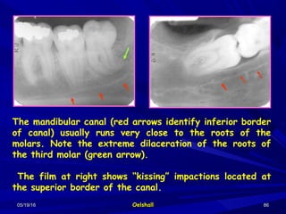 05/19/1605/19/16 OelshallOelshall 8686
The mandibular canal (red arrows identify inferior border
of canal) usually runs very close to the roots of the
molars. Note the extreme dilaceration of the roots of
the third molar (green arrow).
The film at right shows “kissing” impactions located at
the superior border of the canal.
 