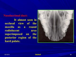 05/19/1605/19/16 OelshallOelshall 8888
Nasolacrimal duct:
It almost seen in
occlusal view of the
maxilla as a round
radiolucent area
superimposed on the
posterior region of the
hard palate.
 