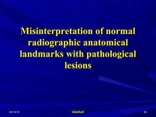 05/19/1605/19/16 OelshallOelshall 9090
Misinterpretation of normalMisinterpretation of normal
radiographic anatomicalradiographic anatomical
landmarks with pathologicallandmarks with pathological
lesionslesions
 