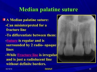 05/19/1605/19/16 OelshallOelshall 9191
Median palatine sutureMedian palatine suture
A Median palatine suture:
-Can misinterpreted for a
fracture line
-To differentiate between them:
-Suture is regular and is
surrounded by 2 radio- opaque
lines
-While Fracture line is irregular
and is just a radiolucent line
without definite borders.
 