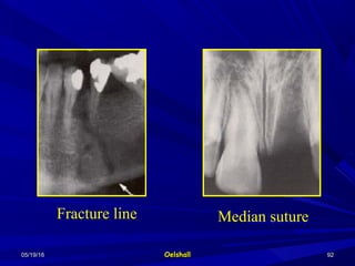 05/19/1605/19/16 OelshallOelshall 9292
Fracture line Median suture
 