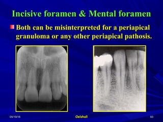 05/19/1605/19/16 OelshallOelshall 9393
Incisive foramen & Mental foramenIncisive foramen & Mental foramen
Both can be misinterpreted for a periapicalBoth can be misinterpreted for a periapical
granuloma or any other periapical pathosis.granuloma or any other periapical pathosis.
 