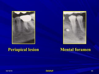 05/19/1605/19/16 OelshallOelshall 9595
Periapical lesionPeriapical lesion Mental foramenMental foramen
 
