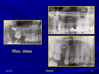 05/19/1605/19/16 OelshallOelshall 9797
Max. sinus
cyst
cyst
sinus
sinus
 