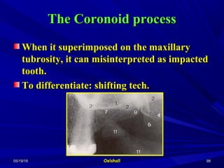 05/19/1605/19/16 OelshallOelshall 9898
The Coronoid processThe Coronoid process
When it superimposed on the maxillaryWhen it superimposed on the maxillary
tubrosity, it can misinterpreted as impactedtubrosity, it can misinterpreted as impacted
tooth.tooth.
To differentiate: shifting tech.To differentiate: shifting tech.
 