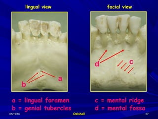 Genial Tubercle Lingual Foramen Genial Tubercle Lingual Foramen
