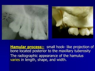 Hamulus Radiographic Anatomical Landmarks | PPSX