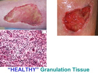 “HEALTHY” Granulation Tissue 
 