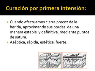  Cuando efectuamos cierre precoz de la
herida, aproximando sus bordes de una
manera estable y definitiva: mediante puntos
de sutura.
 Aséptica, rápida, estética, fuerte.
 