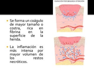 Se forma un coágulo
de mayor tamaño o
costra, rica en
fibrina en la
superficie de la
herida.
 La inflamación es
más intensa por
mayor volumen de
los restos
necróticos.
 