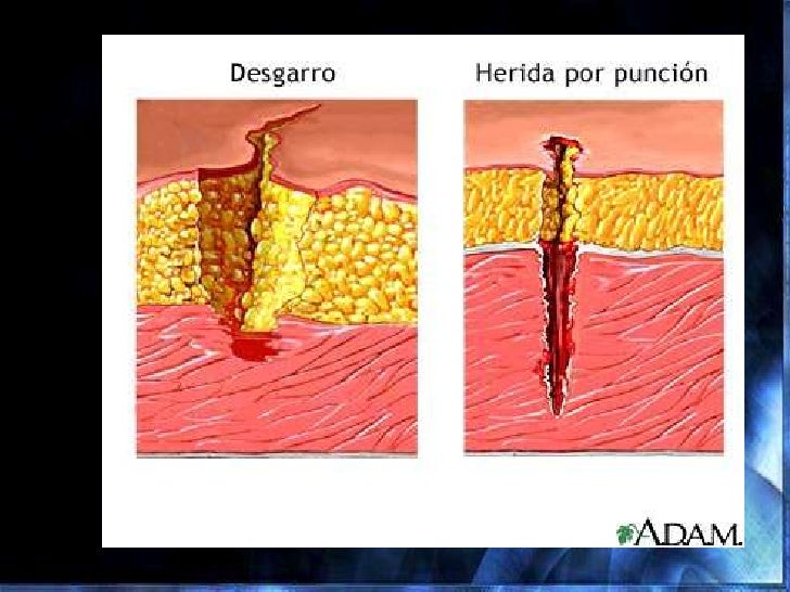 Reparacion de tejidos