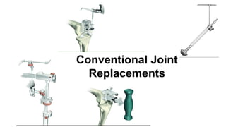 Advancements in Robotic Total Knee Replacement Surgery: Precision and ...