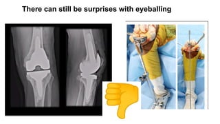 Advancements in Robotic Total Knee Replacement Surgery: Precision and ...