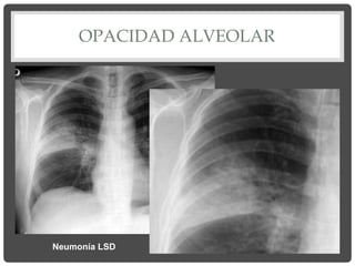 OPACIDAD ALVEOLAR
Neumonía LSD
 