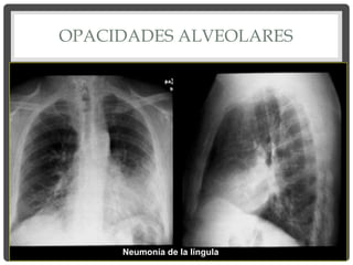 OPACIDADES ALVEOLARES
Neumonía de la língula
 