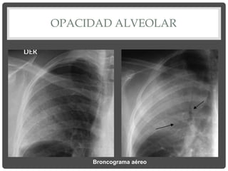 OPACIDAD ALVEOLAR
Broncograma aéreo
 