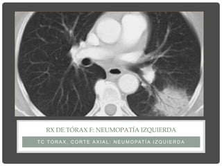 T C TO R A X , C O RT E A X I A L : N E U M O PAT Í A I Z Q U I E R D A
RX DE TÓRAX F: NEUMOPATÍA IZQUIERDA
 