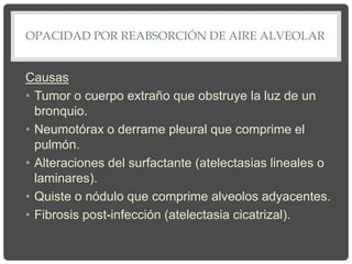 OPACIDAD POR REABSORCIÓN DE AIRE ALVEOLAR
Causas
• Tumor o cuerpo extraño que obstruye la luz de un
bronquio.
• Neumotórax o derrame pleural que comprime el
pulmón.
• Alteraciones del surfactante (atelectasias lineales o
laminares).
• Quiste o nódulo que comprime alveolos adyacentes.
• Fibrosis post-infección (atelectasia cicatrizal).
 