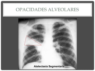 OPACIDADES ALVEOLARES
Atelectasia Segmentaria
 