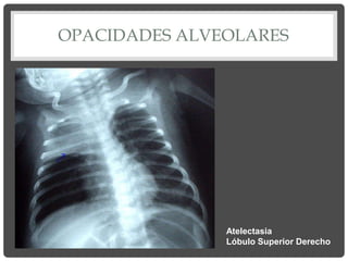 OPACIDADES ALVEOLARES
Atelectasia
Lóbulo Superior Derecho
 