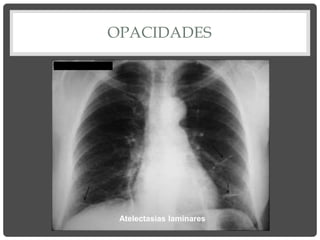 OPACIDADES
Atelectasias laminares
 