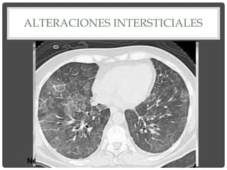 ALTERACIONES INTERSTICIALES
Neumopatía atípica: Mycoplasma pneumoniae
Patrón agudo de afectación intersticial
“en vidrio esmerilado”
 