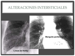 ALTERACIONES INTERSTICIALES
Líneas de Kerley
Manguito peribronquial
 