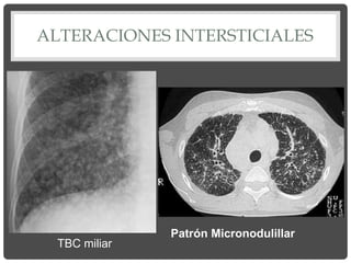 ALTERACIONES INTERSTICIALES
Patrón Micronodulillar
TBC miliar
 