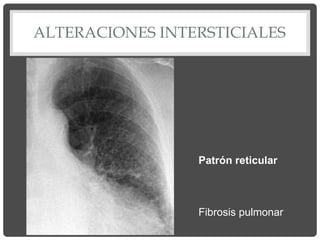 ALTERACIONES INTERSTICIALES
Patrón reticular
Fibrosis pulmonar
 